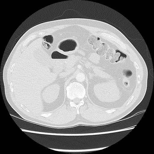 Acute epicardial fat necrosis (Radiopaedia 42327-45440 Axial lung window 58).jpg