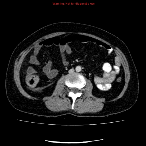 Acute gangrenous cholecystitis (Radiopaedia 10123-10661 Axial C+ portal venous phase 55).jpg