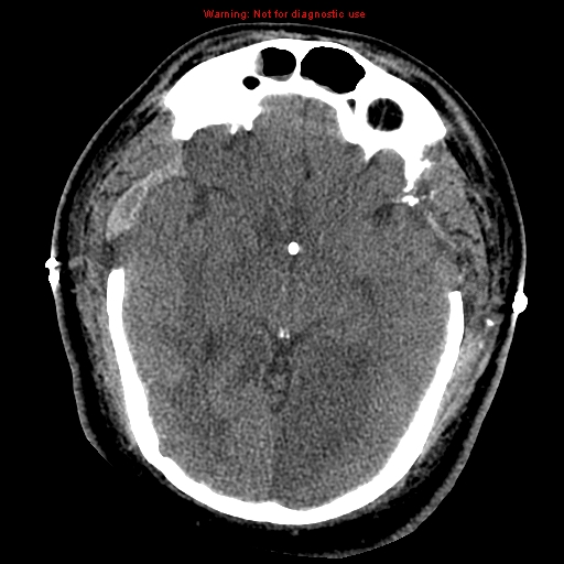 Acute hemorrhagic leukoencephalitis (Radiopaedia 14076-43697 Axial non-contrast 21).jpg