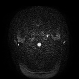 Acute internal carotid artery dissection (Radiopaedia 53541-59632 Axial DWI 1).jpg