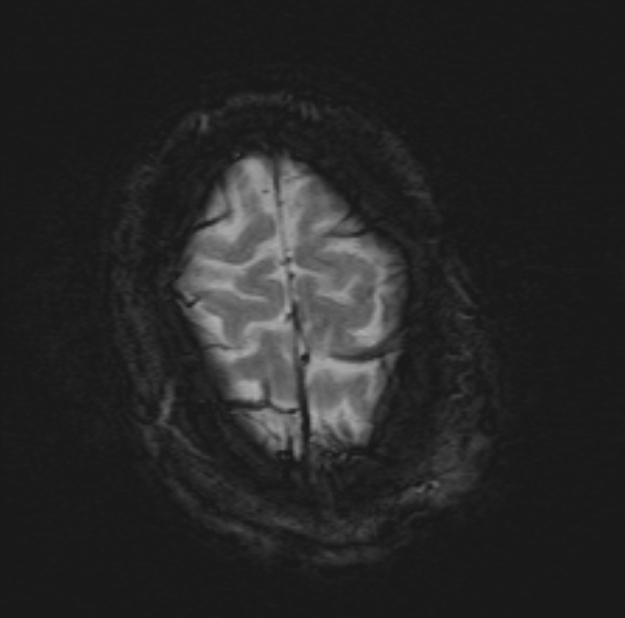 Acute ischemic stroke - posterior circulation territory (Radiopaedia 77670-89880 Axial SWI 53).jpg