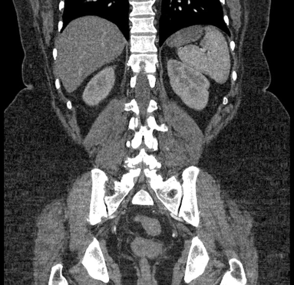 Acute mesenteric ischemia (Radiopaedia 80029-93316 Coronal C+ arterial phase 104).jpg
