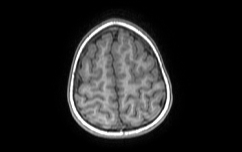 File:Acute necrotizing encephalitis of childhood (Radiopaedia 67356-76737 Axial T1 14).jpg