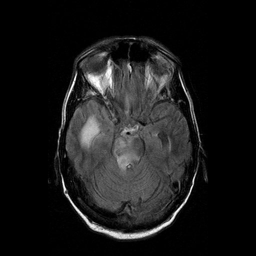 File:Acute necrotizing toxoplasma encephalitis (Radiopaedia 10683-11149 Axial FLAIR 12).jpg