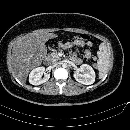 File:Acute on chronic pancreatitis (Radiopaedia 80902-94423 Axial C+ portal venous phase 66).jpg