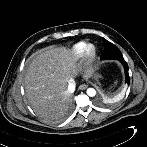 File:Acute pancreatic necrosis (Radiopaedia 13560-13486 Axial C+ portal venous phase 24).jpg
