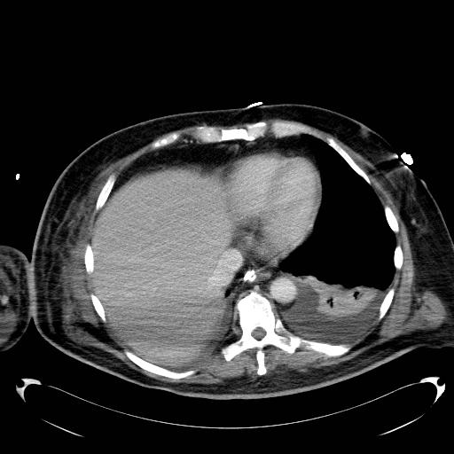 File:Acute pancreatic necrosis (Radiopaedia 13560-18503 Axial C+ portal venous phase 4).jpg