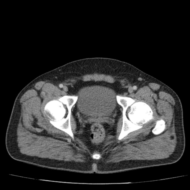 Acute pancreatitis (Radiopaedia 26663-26813 Axial C+ portal venous phase 83).jpg
