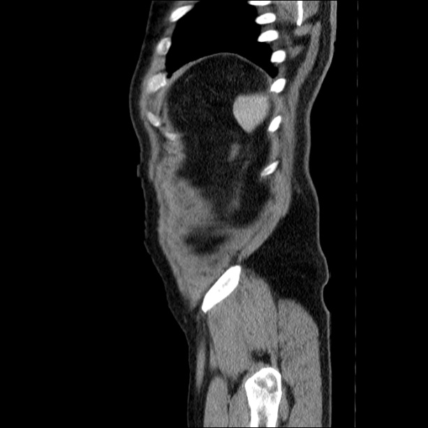 Acute pancreatitis (Radiopaedia 26663-26813 Sagittal C+ portal venous phase 68).jpg