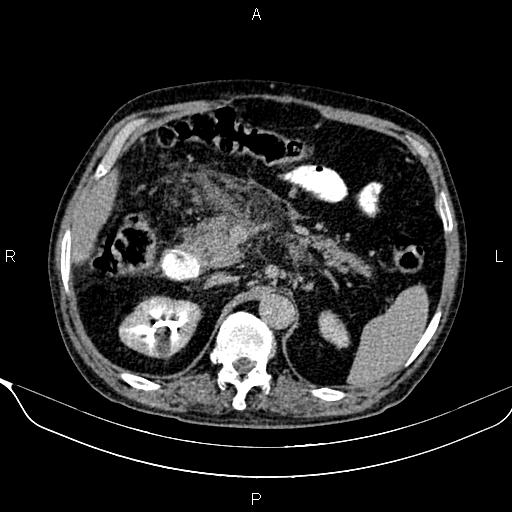 File:Acute pancreatitis (Radiopaedia 85146-100701 Axial C+ delayed 23).jpg