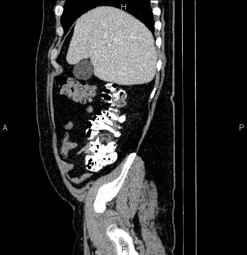 File:Acute pancreatitis (Radiopaedia 85390-101010 Sagittal C+ portal venous phase 16).jpg