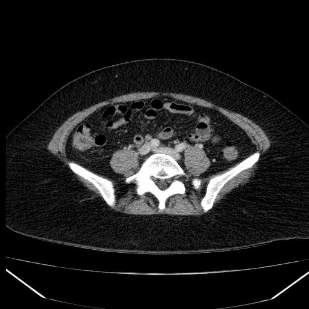 Acute pancreatitis - Balthazar C (Radiopaedia 26569-26714 Axial C+ portal venous phase 67).jpg