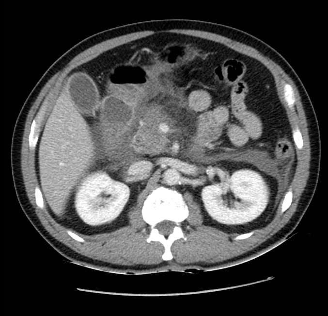 Acute pancreatitis - Balthazar E (Radiopaedia 23080-23110 Axial C+ portal venous phase 25).jpg