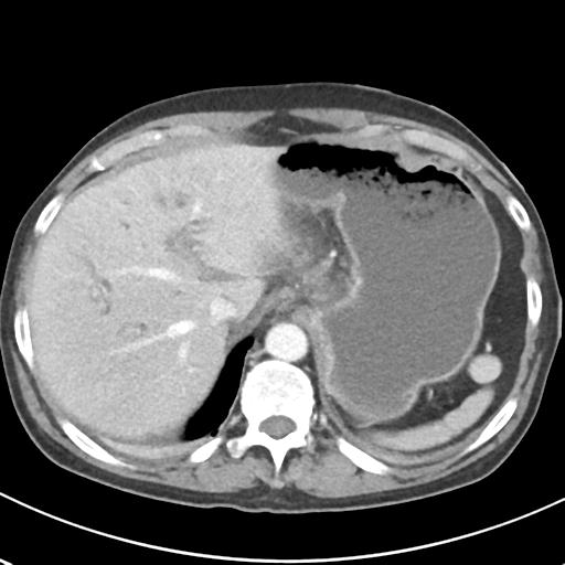 File:Acute pancreatitis and walled-off necrosis (Radiopaedia 29888-30404 Axial C+ portal venous phase 15).jpg