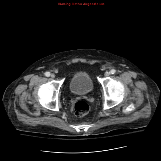 File:Acute pancreatitis with incidental pancreatic lipoma (Radiopaedia 10190-10730 Axial C+ portal venous phase 72).jpg