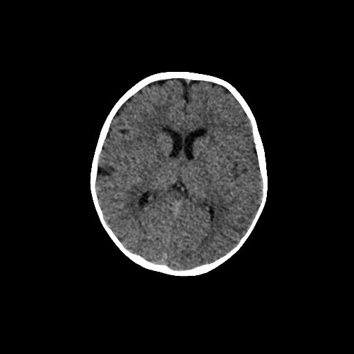 Acute phase of hemiconvulsion-hemiplegia epilepsy syndrome (Radiopaedia 29309-29744 Axial non-contrast 24).jpg
