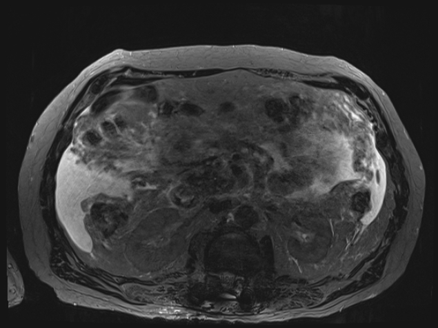 Acute portal vein thrombosis (Radiopaedia 73198-83925 Axial Heavily T2 thin cuts 51).jpg