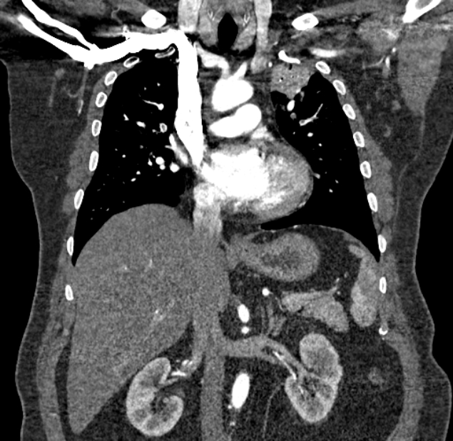 Acute pulmonary embolism with pulmonary infarcts (Radiopaedia 77688-89908 Coronal C+ CTPA 42).jpg