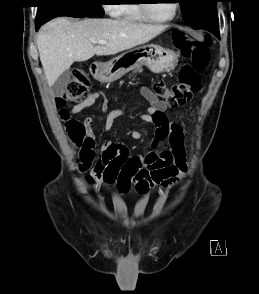 Acute renal infarction (Radiopaedia 59375-66736 Coronal C+ portal venous phase 20).jpg