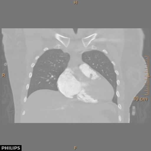 File:Acute reversible pulmonary hypertension and right heart failure from cocaine toxicity (Radiopaedia 49394-54517 Coronal C+ CTPA 12).jpg