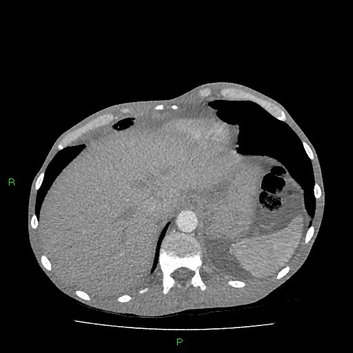 File:Acute right lung abscess (Radiopaedia 34806-36258 Axial C+ arterial phase 165).jpg