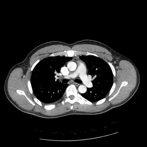File:Acute segmental pulmonary emboli and pulmonary infarction (Radiopaedia 62264-70444 Axial C+ CTPA 48).jpg