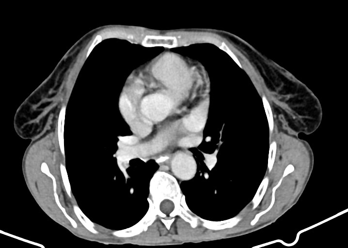 Acute small bowel (ileal) volvulus (Radiopaedia 71740-82139 Axial C+ portal venous phase 12).jpg
