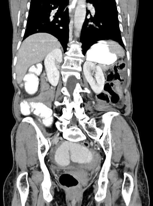Acute small bowel (ileal) volvulus (Radiopaedia 71740-82139 Coronal C+ portal venous phase 77).jpg