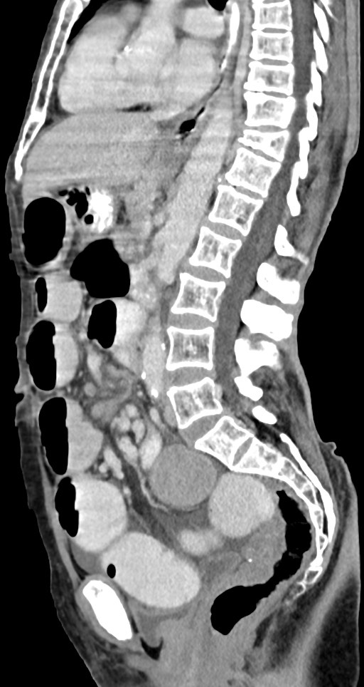 Acute small bowel (ileal) volvulus (Radiopaedia 71740-82139 Sagittal C+ portal venous phase 87).jpg