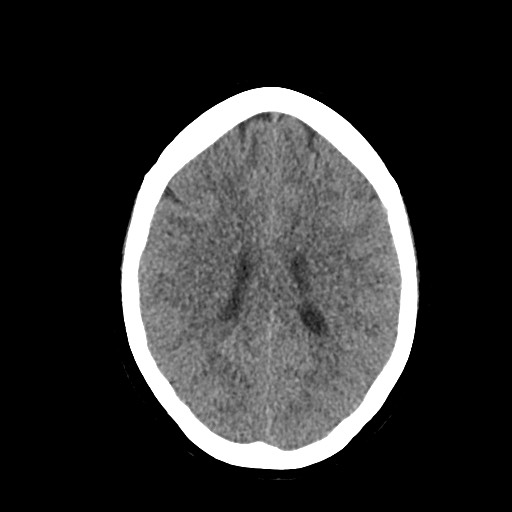 File:Acute subarachnoid hemorrhage and accessory anterior cerebral artery (Radiopaedia 69231-79008 Axial non-contrast 37).jpg