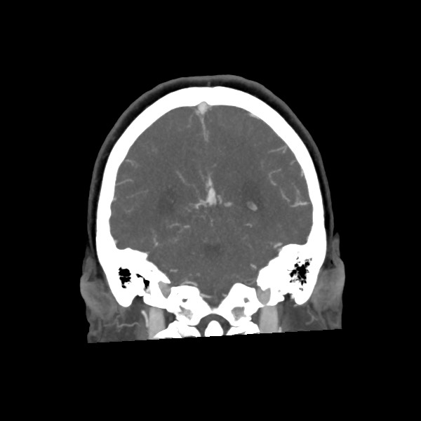 Acute subarachnoid hemorrhage and accessory anterior cerebral artery (Radiopaedia 69231-79009 Coronal C+ arterial phase 57).jpg