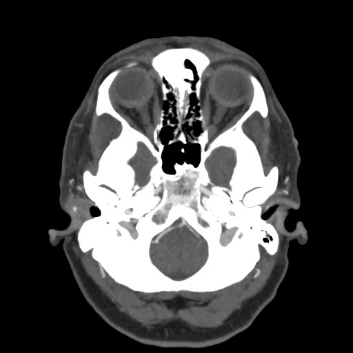 Acute subarachnoid hemorrhage and accessory anterior cerebral artery (Radiopaedia 69231-79009 D 14).jpg