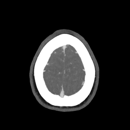 Acute subarachnoid hemorrhage and accessory anterior cerebral artery (Radiopaedia 69231-79009 D 63).jpg