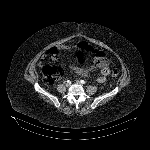 File:Acute superior mesenteric artery occlusion (Radiopaedia 51288-56960 Axial C+ arterial phase 62).jpg