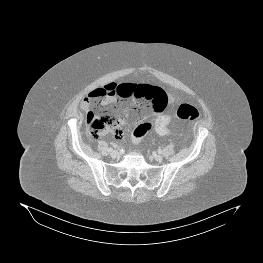 Acute superior mesenteric artery occlusion (Radiopaedia 51288-56960 Axial lung window 56).jpg