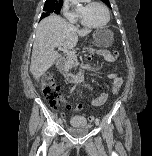 Acute superior mesenteric artery occlusion (Radiopaedia 51288-56960 Coronal C+ portal venous phase 37).jpg