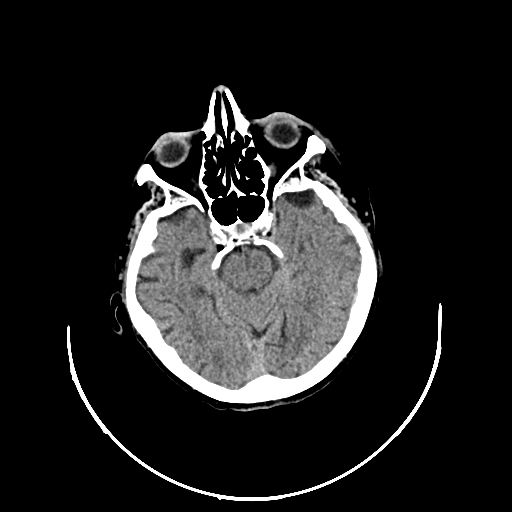 Acute traumatic subdural hematoma (Radiopaedia 82921-97257 Sagittal non-contrast 1).jpg