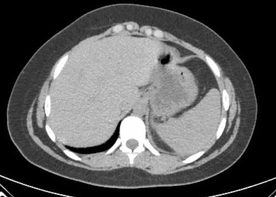 File:Acute unilateral nonhemorrhagic adrenal infarction (Radiopaedia 67560-76957 Axial non-contrast 9).jpg