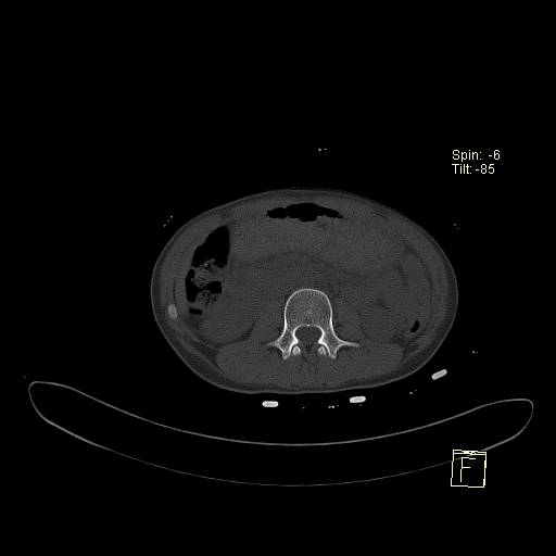 File:Acute vertebral compression fracture (Radiopaedia 63832-72559 Axial bone window 29).jpg
