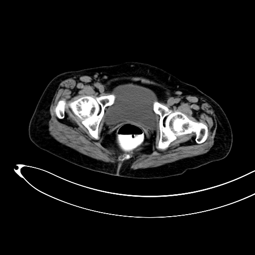 Adenocarcinoma colon with intussusception (Radiopaedia 86006-101922 Axial non-contrast 61).jpg