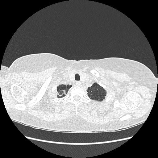 Adenocarcinoma in situ of lung (Radiopaedia 38685-40829 B 18).png