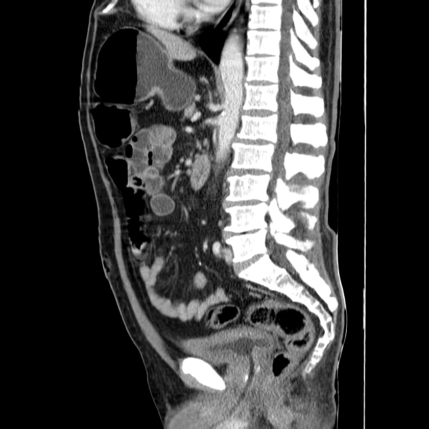 Adenocarcinoma of colon with entero-colic fistula (Radiopaedia 22832-22852 Sagittal C+ portal venous phase 35).jpg