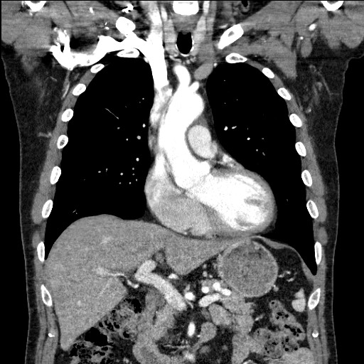 Adenocarcinoma of the lung (Radiopaedia 59871-67325 Coronal C+ arterial phase 26).jpg