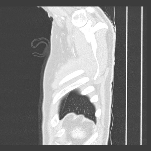 Adenocarcinoma of the lung (Radiopaedia 59871-67325 Sagittal lung window 97).jpg
