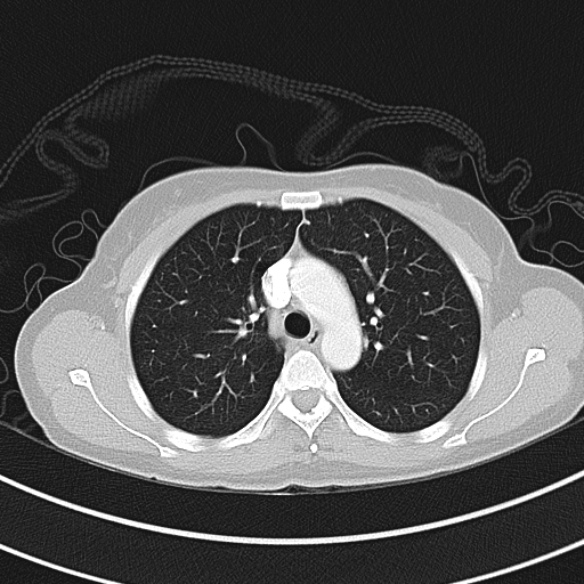 File:Adenocystic carcinoma of the trachea (Radiopaedia 47677-52525 Axial lung window 43).jpg