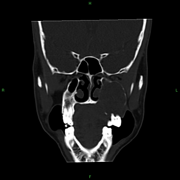 File:Adenoid cystic carcinoma of hard palate (Radiopaedia 26137-26273 Coronal bone window 12).jpg