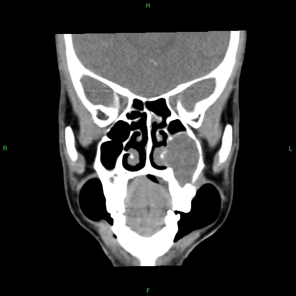 File:Adenoid cystic carcinoma of hard palate (Radiopaedia 26137-26273 Coronal liver window 10).jpg