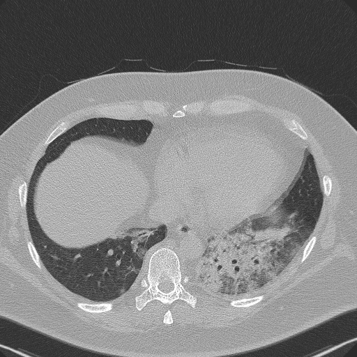 Adenoid cystic carcinoma of the trachea (Radiopaedia 49042-54137 Axial lung window 261).jpg