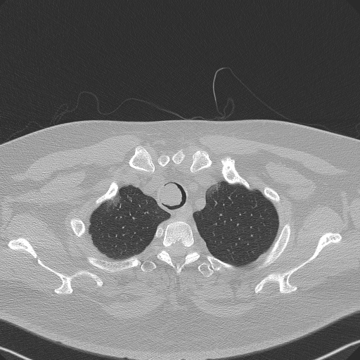 Adenoid cystic carcinoma of the trachea (Radiopaedia 49042-54137 Axial lung window 47).jpg
