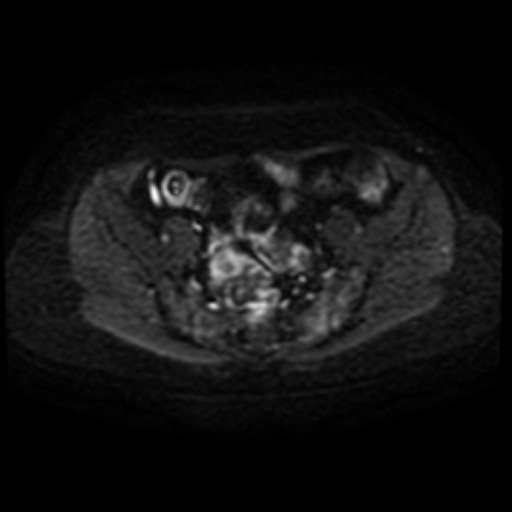 Adenoma malignum of cervix (Radiopaedia 66441-75705 Axial DWI 29).jpg